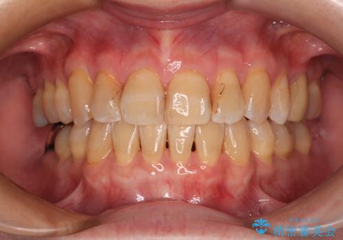 【モニター】前歯の突出感を抜歯矯正で改善の症例 治療後