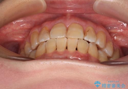 【モニター】前歯の突出感を抜歯矯正で改善の治療後