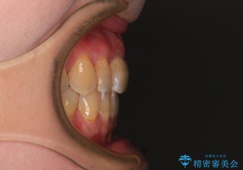 【モニター】前歯の突出感を抜歯矯正で改善の治療後