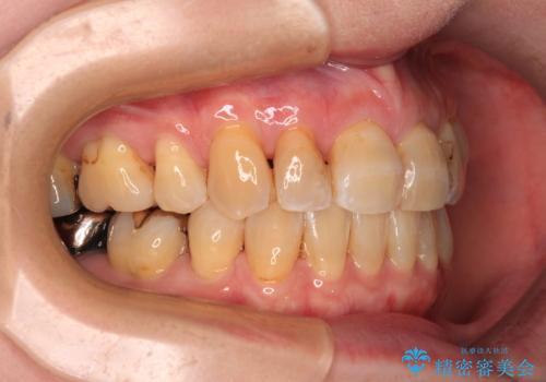 【モニター】前歯の突出感を抜歯矯正で改善の治療後