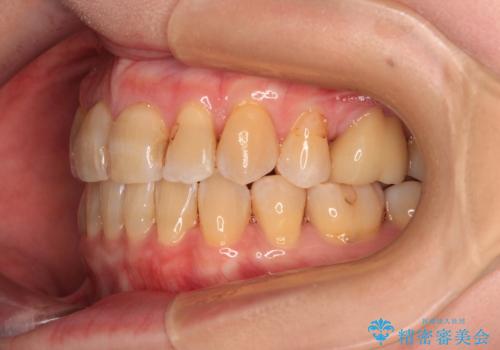 【モニター】前歯の突出感を抜歯矯正で改善の治療後