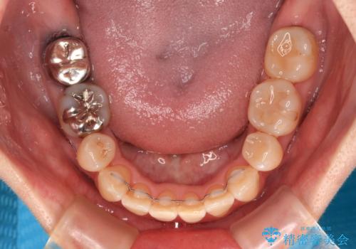 【モニター】前歯の突出感を抜歯矯正で改善の治療後