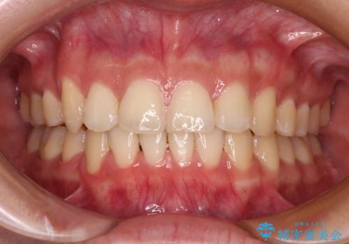 八重歯の抜歯矯正 補助装置とワイヤーを併用したインビザライン矯正治療の症例 治療後