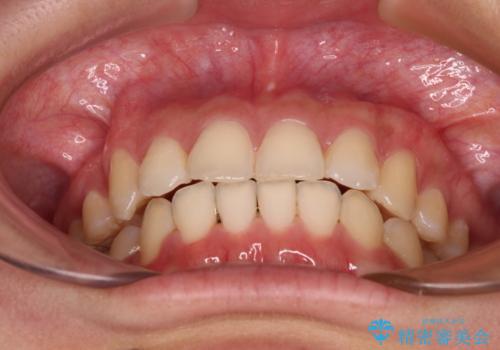 八重歯の抜歯矯正 補助装置とワイヤーを併用したインビザライン矯正治療の治療後