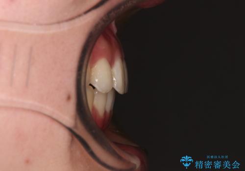 八重歯の抜歯矯正　補助装置とワイヤーを併用したインビザライン矯正治療の治療後