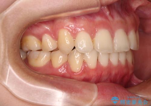 八重歯の抜歯矯正　補助装置とワイヤーを併用したインビザライン矯正治療の治療後