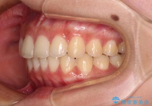 八重歯の抜歯矯正 補助装置とワイヤーを併用したインビザライン矯正治療の治療後
