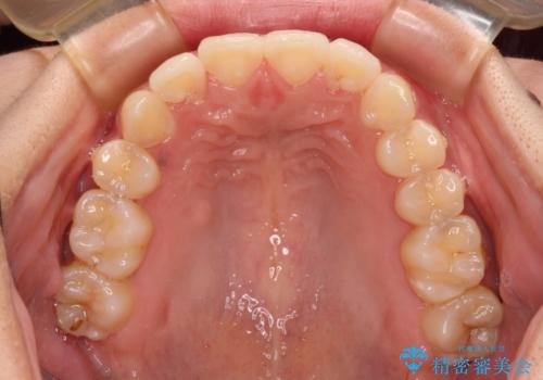 八重歯の抜歯矯正 補助装置とワイヤーを併用したインビザライン矯正治療の治療後