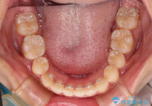八重歯の抜歯矯正 補助装置とワイヤーを併用したインビザライン矯正治療の治療後