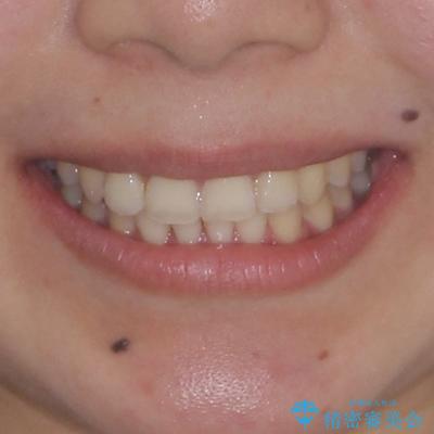 八重歯の抜歯矯正　補助装置とワイヤーを併用したインビザライン矯正治療の治療後（顔貌）