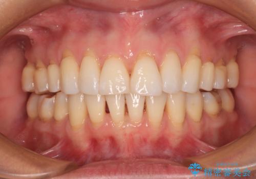 後戻りで突出した口元を引っ込めたい インビザライン矯正治療の症例 治療後