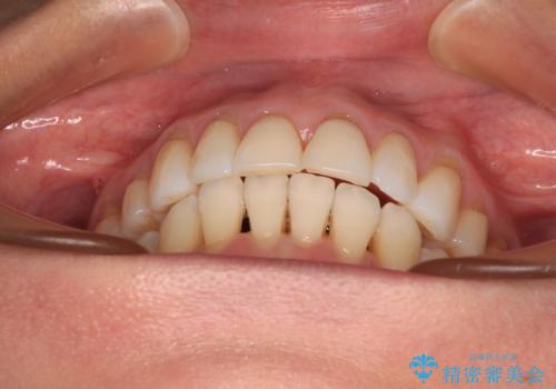 後戻りで突出した口元を引っ込めたい インビザライン矯正治療の治療後