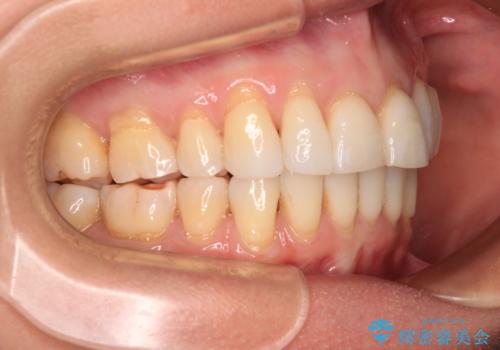 後戻りで突出した口元を引っ込めたい インビザライン矯正治療の治療後