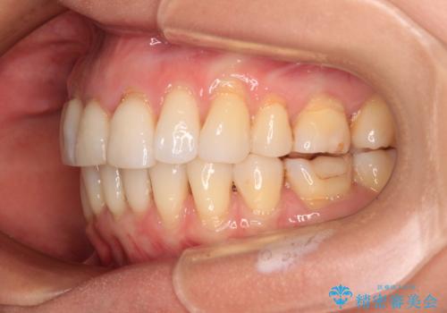 後戻りで突出した口元を引っ込めたい インビザライン矯正治療の治療後