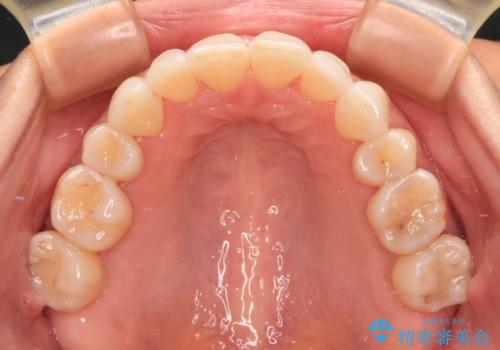 後戻りで突出した口元を引っ込めたい インビザライン矯正治療の治療後