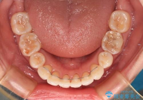 後戻りで突出した口元を引っ込めたい インビザライン矯正治療の治療後