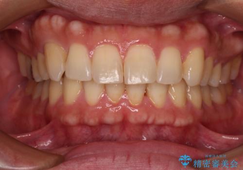 遠方からの通院 インビザライン矯正治療の症例 治療後