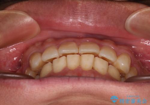 遠方からの通院 インビザライン矯正治療の治療後