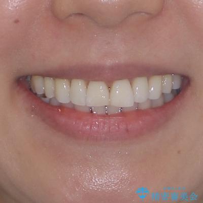 後戻りで突出した口元を引っ込めたい インビザライン矯正治療の治療後(顔貌)
