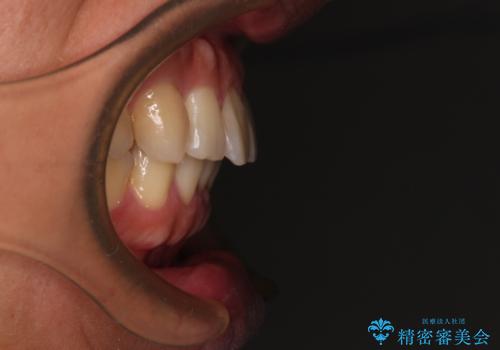 遠方からの通院 インビザライン矯正治療の治療後