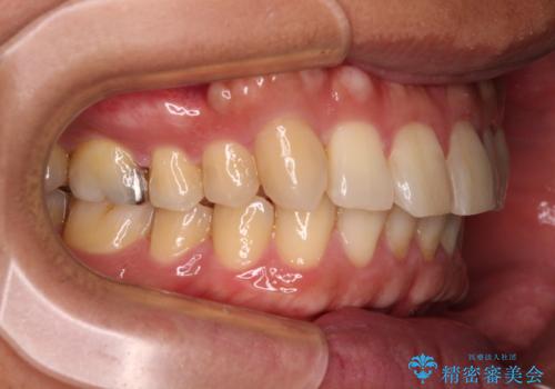 遠方からの通院 インビザライン矯正治療の治療後