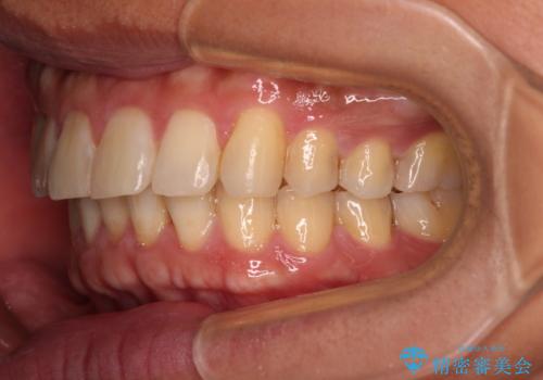 遠方からの通院 インビザライン矯正治療の治療後