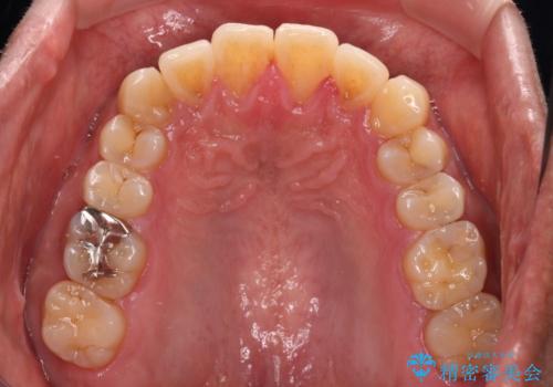 遠方からの通院 インビザライン矯正治療の治療後