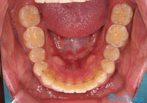 遠方からの通院 インビザライン矯正治療の治療後