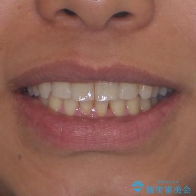 遠方からの通院 インビザライン矯正治療の治療後(顔貌)
