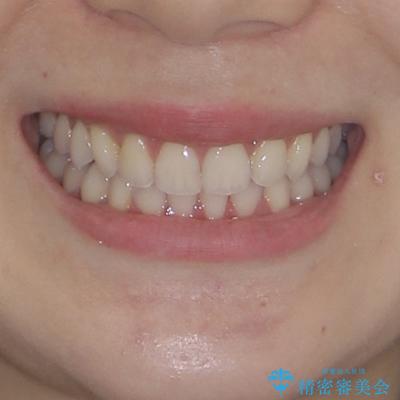 前歯のデコボコと深い咬み合わせ　インビザラインできれいに改善の治療後（顔貌）