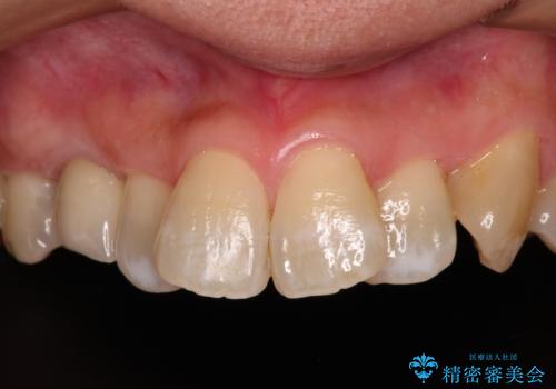 虫歯で失われた前歯　インプラントによる補綴治療の治療後
