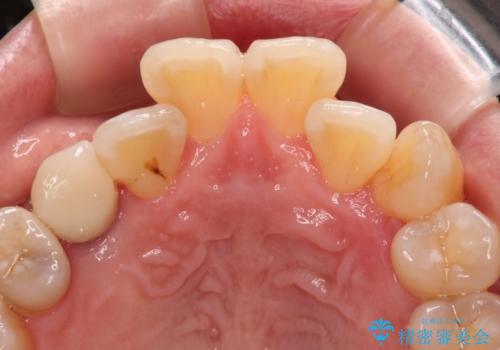 虫歯で失われた前歯　インプラントによる補綴治療の治療後