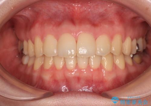 デコボコ歯列をきれいに インビザラインによる矯正治療の症例 治療後