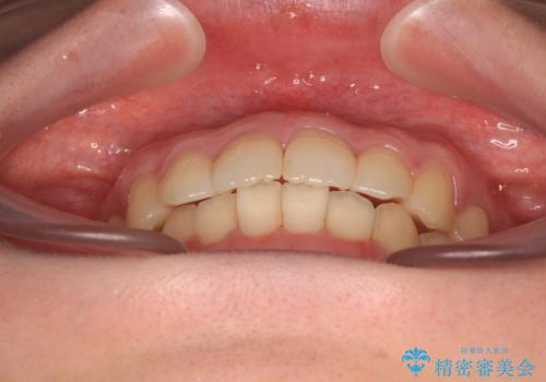デコボコ歯列をきれいに インビザラインによる矯正治療の治療後