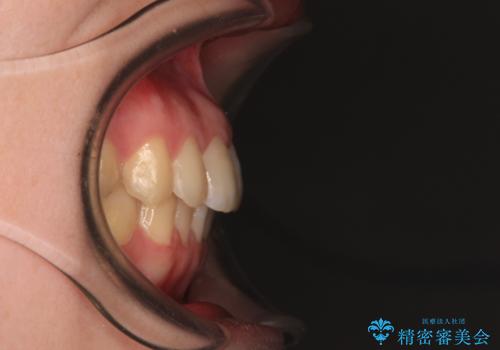 デコボコ歯列をきれいに インビザラインによる矯正治療の治療後