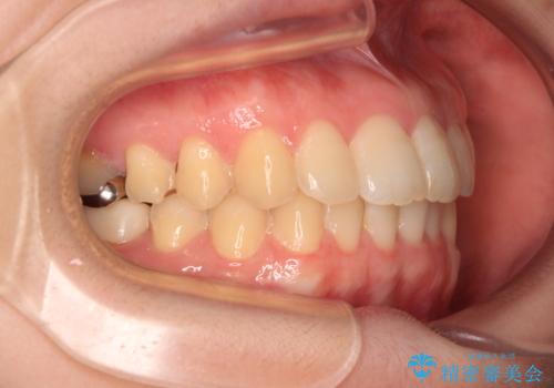 デコボコ歯列をきれいに インビザラインによる矯正治療の治療後