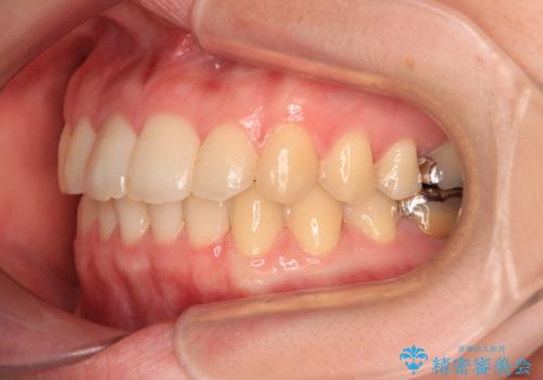 デコボコ歯列をきれいに　インビザラインによる矯正治療の治療後