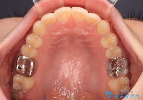 デコボコ歯列をきれいに インビザラインによる矯正治療の治療後
