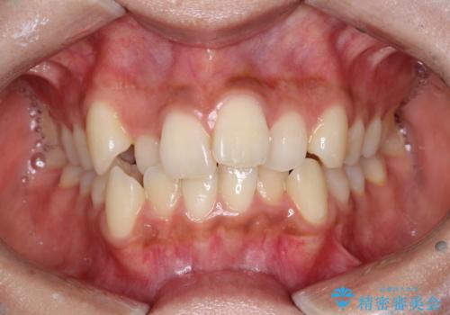 【審美装置】前歯の凸凹、抜歯矯正の症例 治療前
