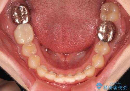 デコボコ歯列をきれいに インビザラインによる矯正治療の治療後