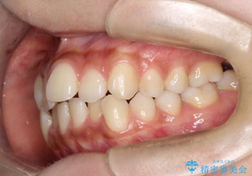 【審美装置】前歯の凸凹、抜歯矯正の治療前