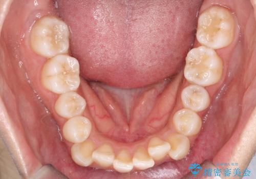 【審美装置】前歯の凸凹、抜歯矯正の治療前