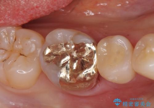 劣化した保険の詰め物部分の治療をしたい。の症例 治療後