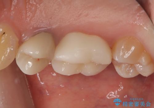 物が詰まりやすく歯茎が腫れるの治療後