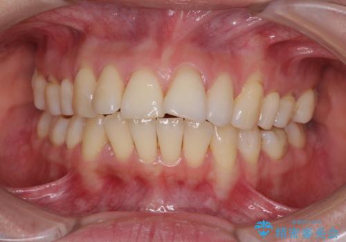 後戻りで突出した口元を引っ込めたい インビザライン矯正治療の症例 治療前
