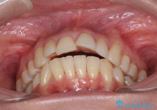 後戻りで突出した口元を引っ込めたい インビザライン矯正治療の治療前