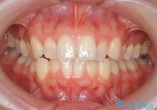前歯のがたつきをしっかり治すマウスピース矯正の症例 治療前