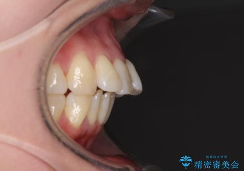 後戻りで突出した口元を引っ込めたい インビザライン矯正治療の治療前