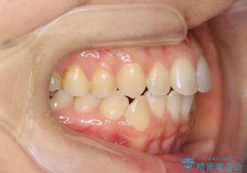 前歯のがたつきをしっかり治すマウスピース矯正の治療前