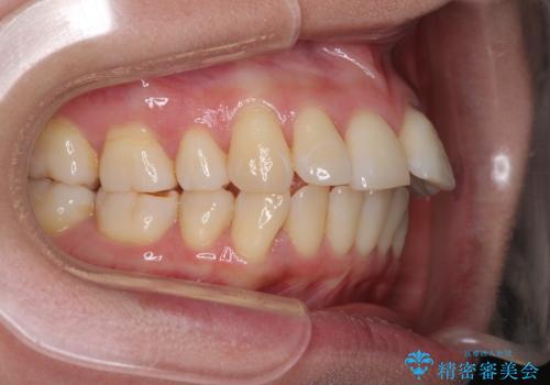 後戻りで突出した口元を引っ込めたい インビザライン矯正治療の治療前